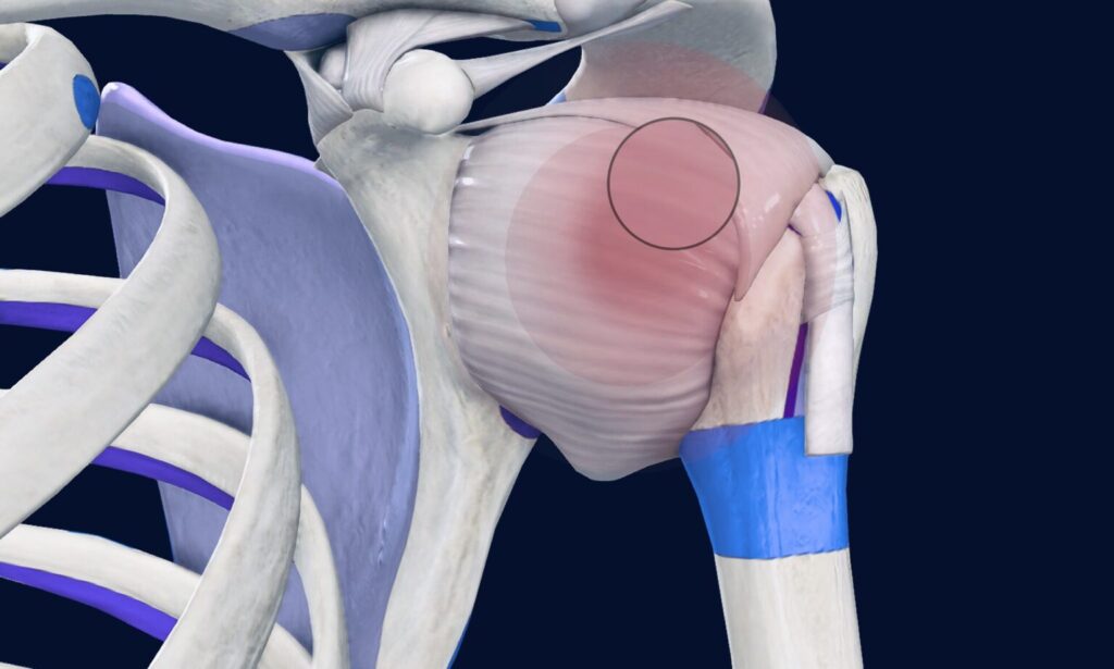 Frozen shoulder